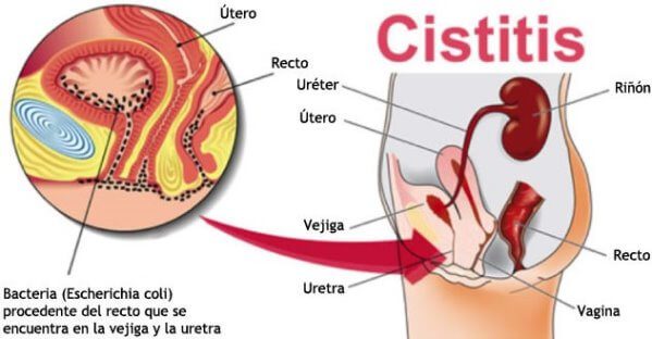 la cistitis aguda y crónica