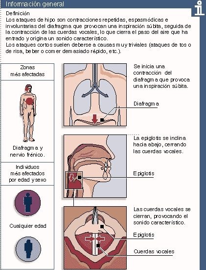 definición de hipo