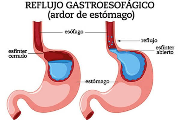 Acidez de Estómago - Síntomas y Tratamientos | CurioSfera.com