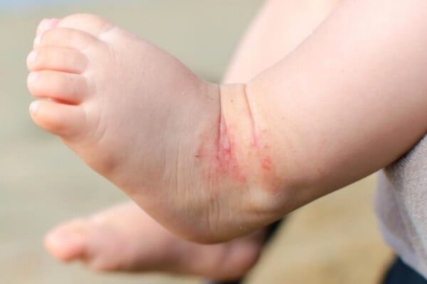 causas y sintomas dermatitis atópica